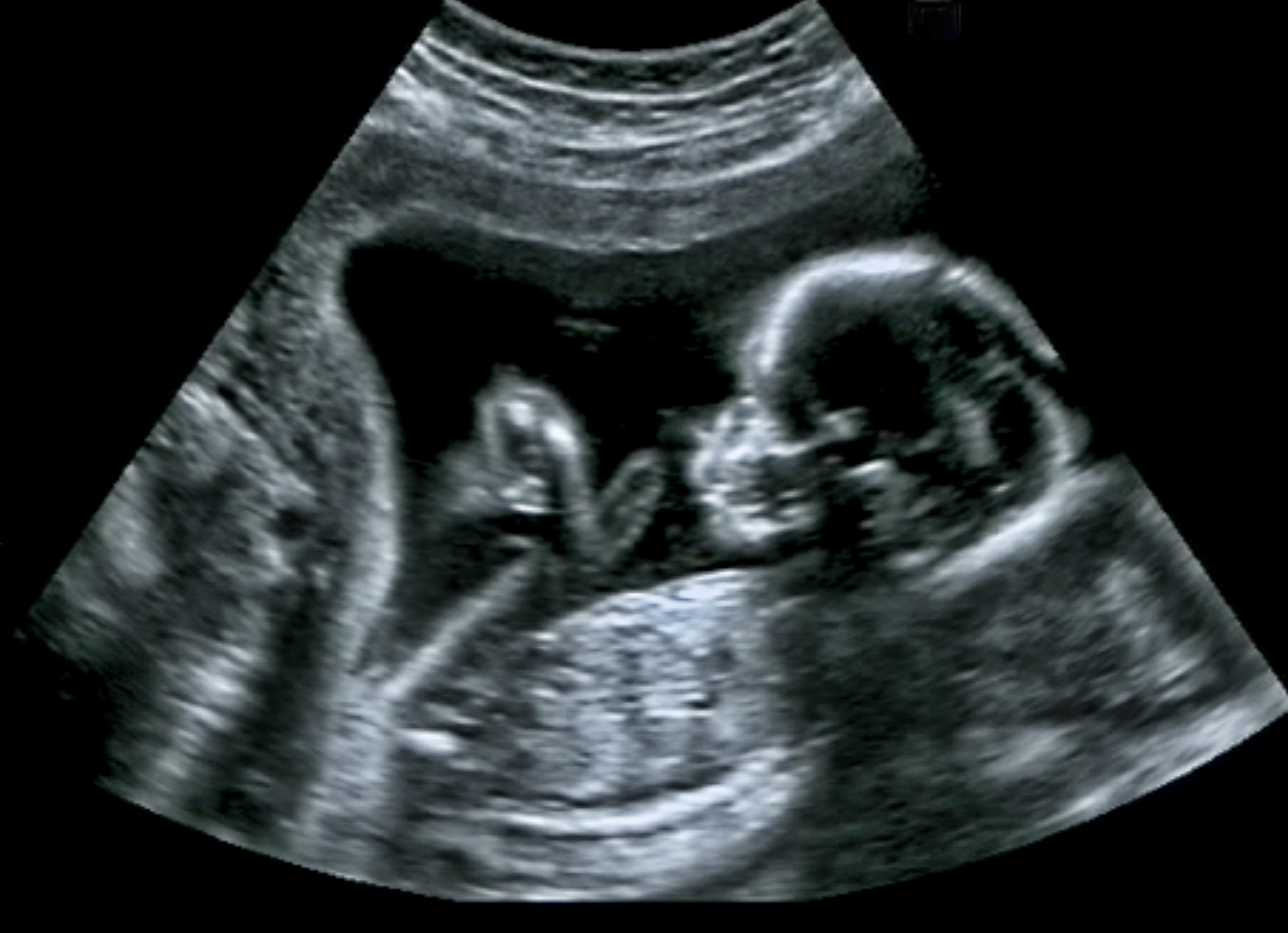 Ultrasound,Of,Baby,In,Mother's,Womb. Young,Afro-american,Pregnant,Woman,In,Safety,At,Ultrasound,Office,In
